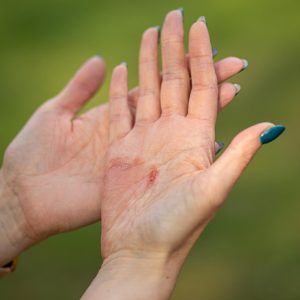 Psoriazis