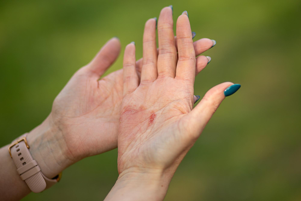 Psoriazis