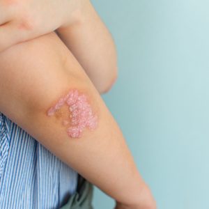 Psoriazis