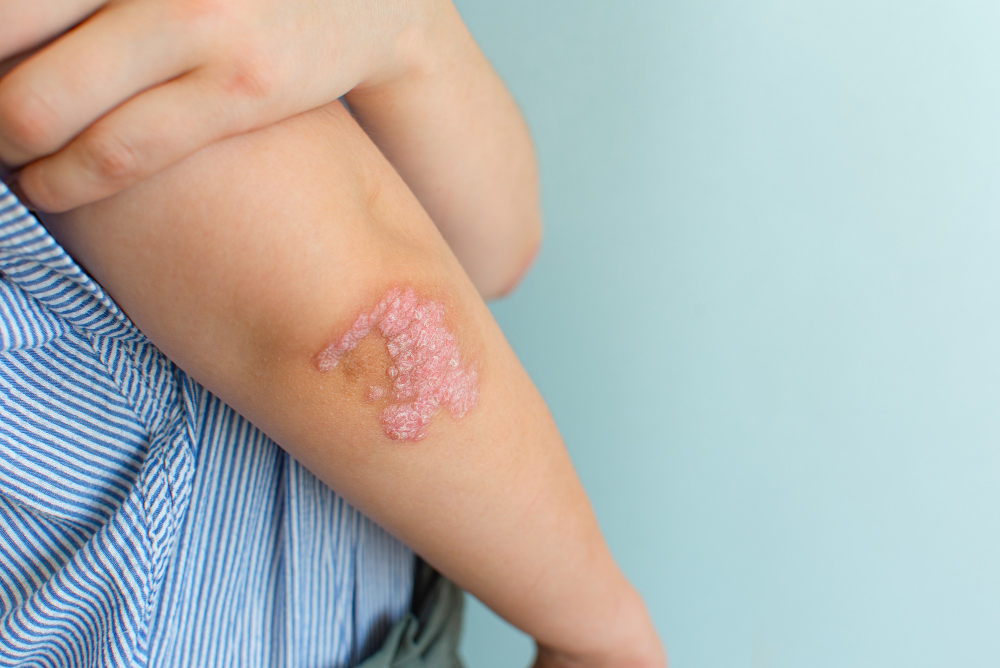 Psoriazis